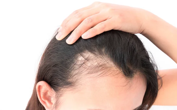 Close-up of a woman holding her hair back to reveal thinning hair near the hairline. The image highlights hair loss and a visible scalp against a white background.